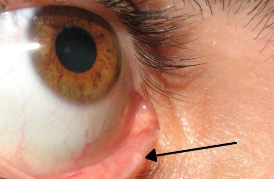 Majhna, a zelo pomembna: čemu služi luknjica na dnu očesne veke