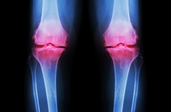 osteoartritis kolena