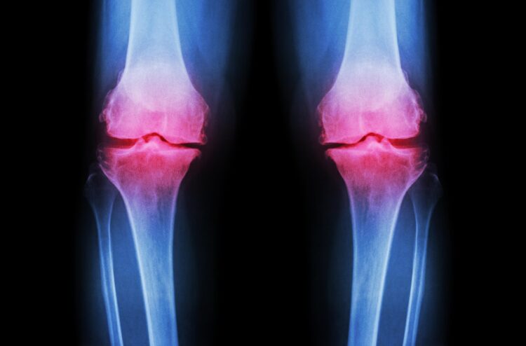 osteoartritis kolena